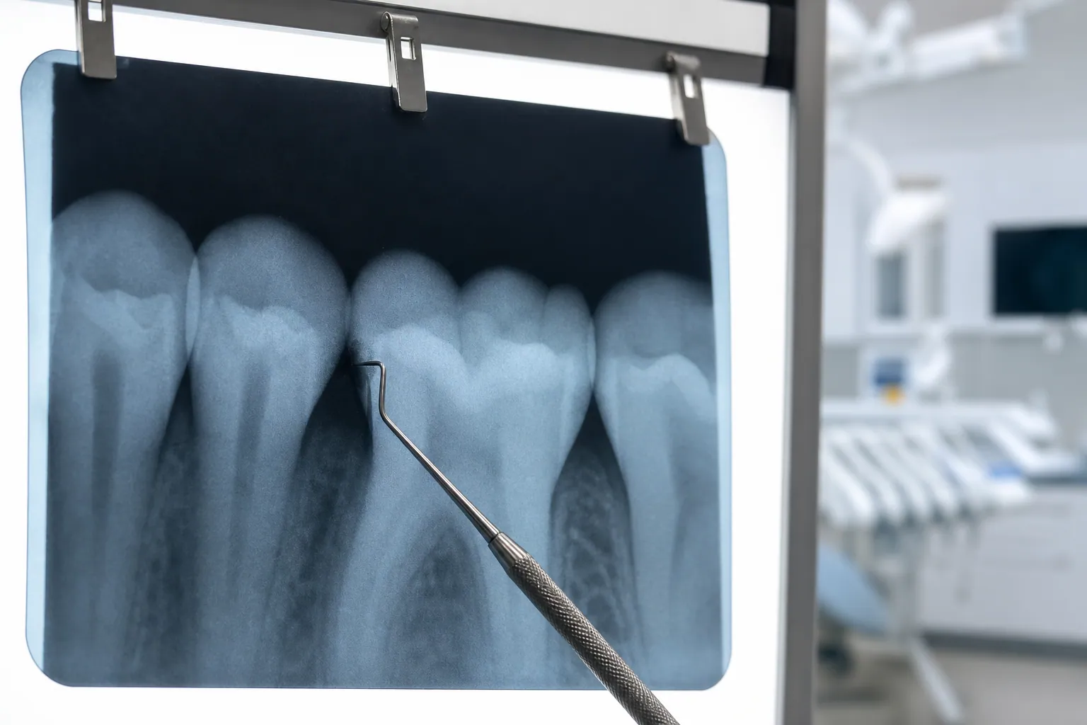 Dental explorer pointing to a tooth on an X-ray in the clinic