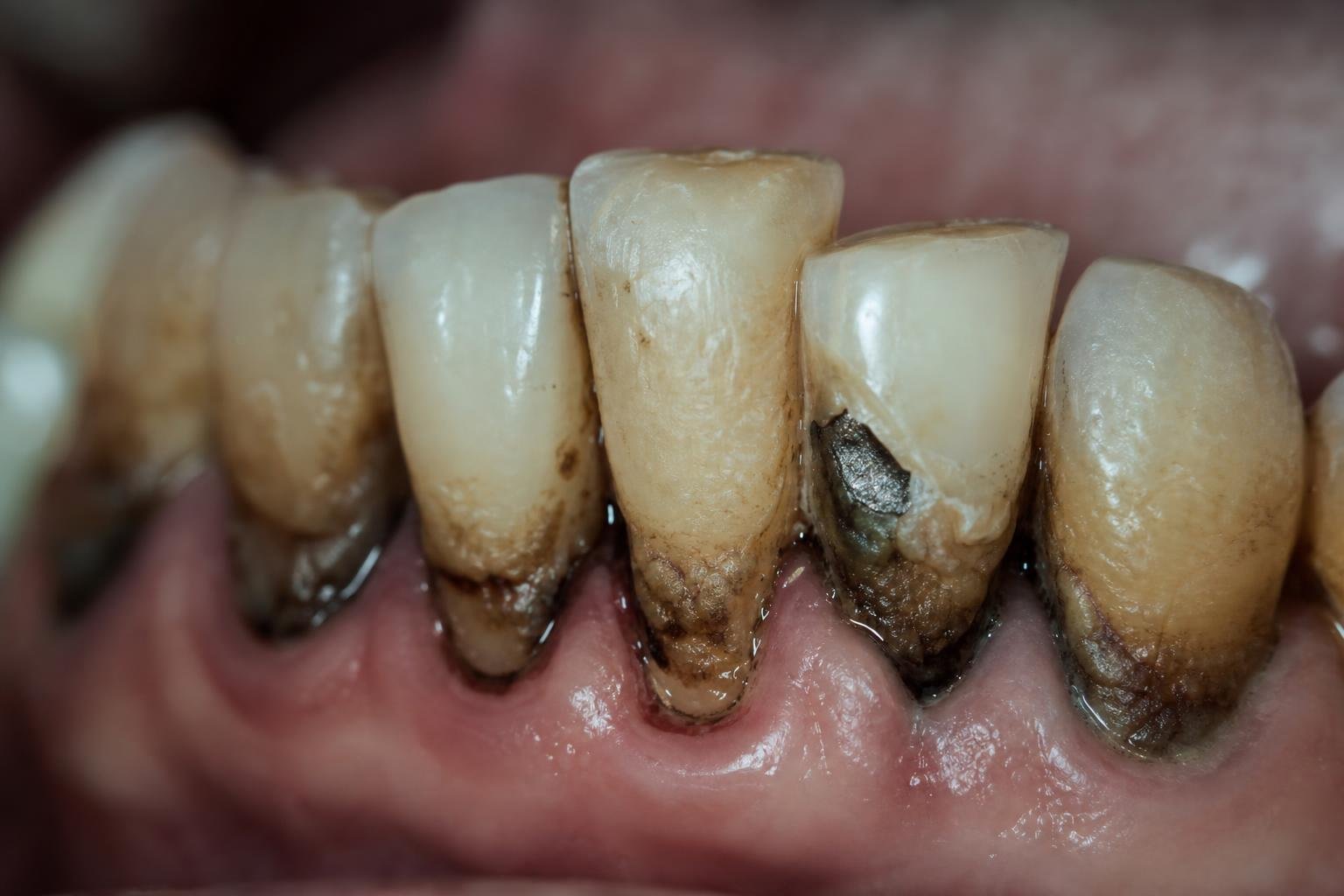 Severely decayed and stained lower teeth before treatment
